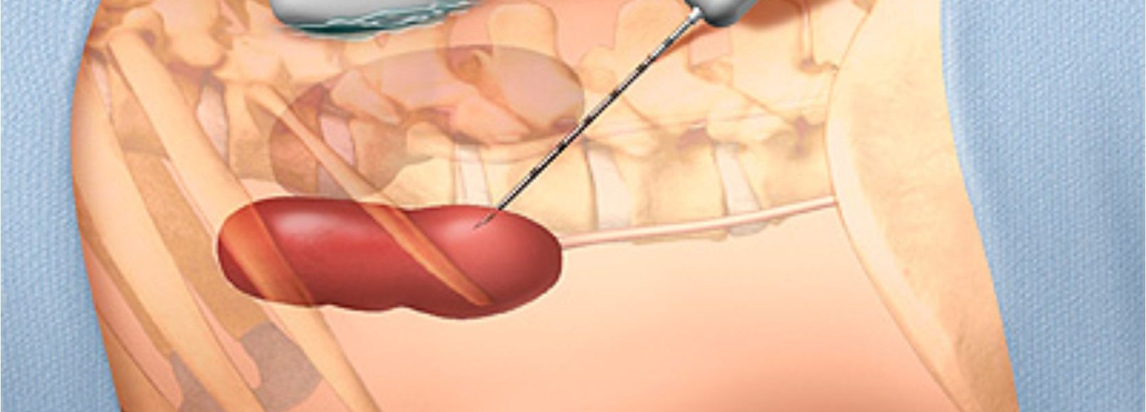 Які ризики пов'язані з біопсією при онкології?