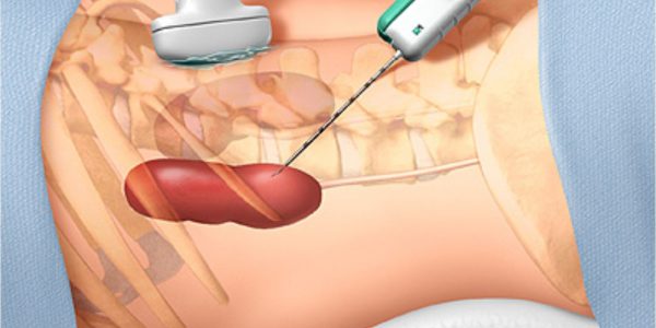 Які ризики пов'язані з біопсією при онкології?