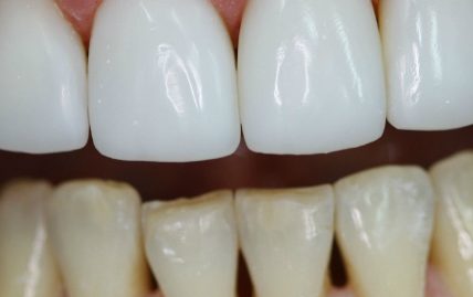 Тотальна реставрація: Вініри чи коронки — що обрати для ідеальної усмішки?