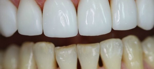 Тотальна реставрація: Вініри чи коронки — що обрати для ідеальної усмішки?