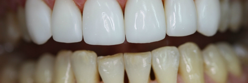 Тотальна реставрація: Вініри чи коронки — що обрати для ідеальної усмішки?
